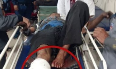 भिलाई स्टील प्लांट में कार्य के दौरान मजदूर का कटा पैर