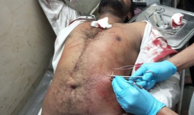 भिलाई में बर्थडे पार्टी के दौरान चाकूबाजी में कई घायल, पेट की अतड़ी निकल गई बाहर