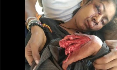 गेम खेलने के दौरान ब्लास्ट हुआ मोबाइल, नबालिग की अंगुलियां उड़ीं, आंखों पर भी गहरी चोटें