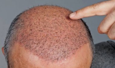 हेयर ट्रांसप्लांट कराने पर इंजीनियर की हुई मौत, डॉक्टर पर FIR दर्ज